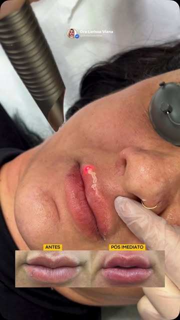 Lábios bonitos não precisam parecer preenchidos. 👄

O Fotona Lips é um tratamento a laser pensado p