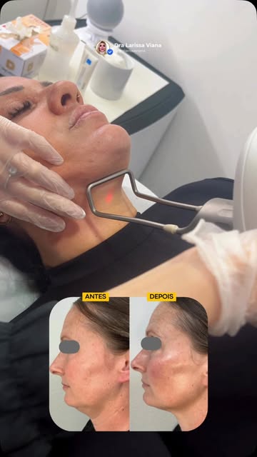Papada não é só gordura — e é por isso que tratar apenas “volume” nem sempre entrega o contorno que 