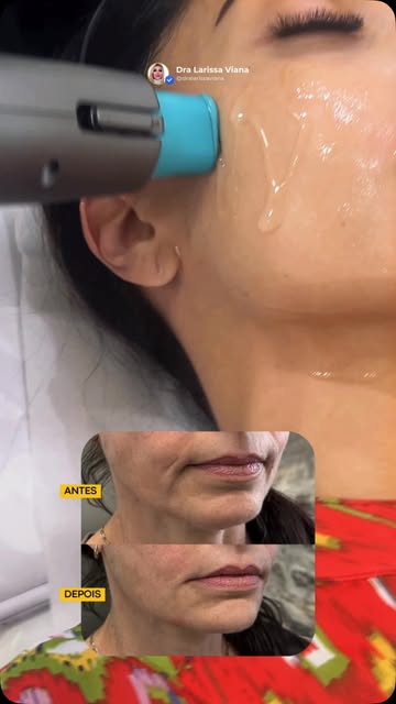 Seu rosto não precisa mudar. Ele precisa recuperar sustentação. 

Quando a flacidez começa a aparece
