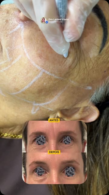 Um olhar cansado nem sempre significa cansaço. 

A flacidez ao redor dos olhos pode deixar a express