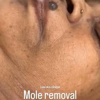Quick and safe procedure for unwanted or suspicious moles

Done under local anesthesia with minimal 