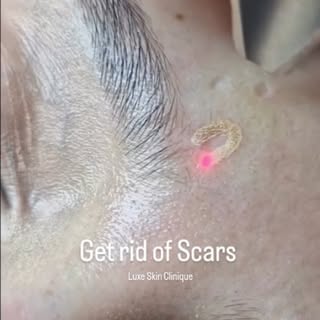 ✨ Every scar has a story, but it doesn't have to define your skin.
Advanced scar reduction treatment