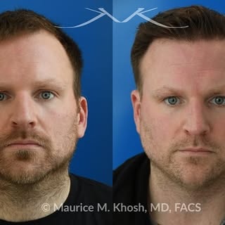 Our patient requested hair restoration for a receding hairline. A follicular extraction transplant (