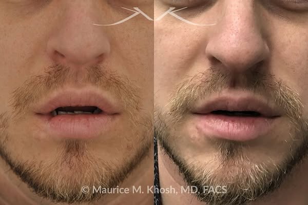 Our patient has previously sustained a dog bite injury, resulting in loss of part of his lower lip. 