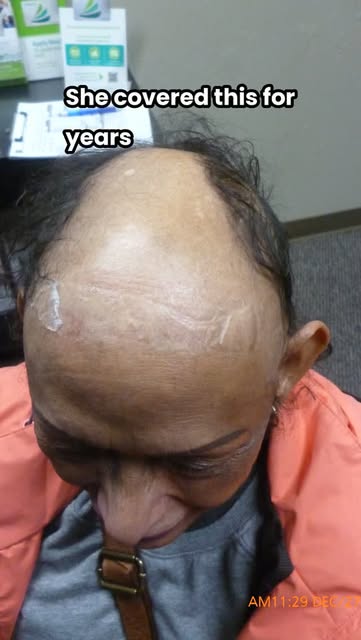 She hid her thinning hair for years. Hats every day. Avoided photos. Did not want anyone to see. New