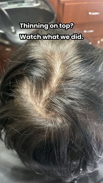 Thinning on top and did not know what to do next. New Look Institute made her a custom hair topper t