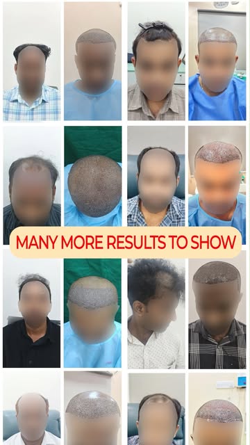 Take a look at these incredible 3–6 Months Post-Surgery Hair Transplant Results from Hair Essentia. 