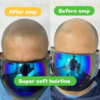 ✅NO MATTER WHAT YOU ARE AFTER , WE’VE GOT YOU COVERED ✅. From Sharp hairlines to soft hairlines or m