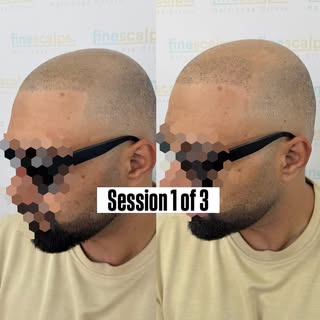 Session 1 of 3 ✅

Even after just the first session, you can already see the difference. We’ve start