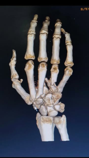 Fracture dislocation of 2nd,3rd,4th and 5th carpometacarpal joints. Reduction and fixation under X R