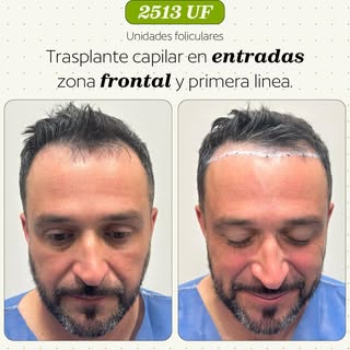 🥇Más de 10 años de experiencia garantizan los mejores resultados tras un #trasplantecapilar. Agenda