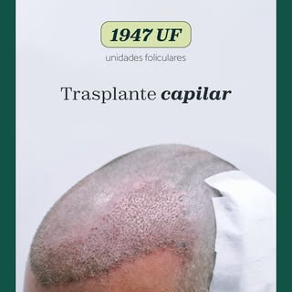 ¿Te gustaría recuperar tu cabello y poder peinarte como antes?

No dejes que tu alopecia te defina, 