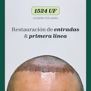 Toma el control de tu imagen y frena tu alopecia hoy.

Agenda una cita conmigo y valoremos tu caso ⬇