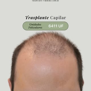 Trasplante Capilar | 6411 Unidades Foliculares 
Cambia tu futuro capilar

𝗔𝗴𝗲𝗻𝗱𝗮 𝘂𝗻𝗮 𝗰𝗶𝘁