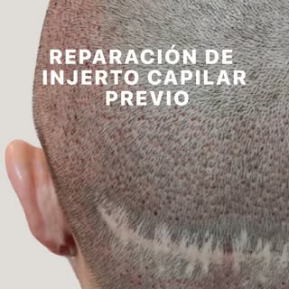 Tu historia capilar no termina con un mal resultado.
👉🏻Si tu primer trasplante no cumplió tus expe