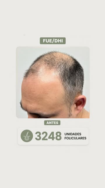 Trasplante Capilar | 6076 Unidades Foliculares
Recupera tu cabello. Recupera tu confianza.

𝗔𝗴𝗲𝗻