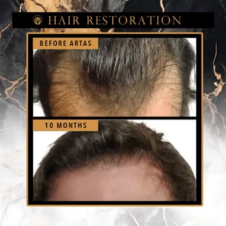 Hair Loss? We’ve Got Solutions.
Whether you’re a man or woman experiencing thinning hair, a receding