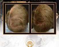 🧬 Regrow Your Hair – Without Surgery! 💥
For Men & Women | Limited-Time Offer

Struggling with hair