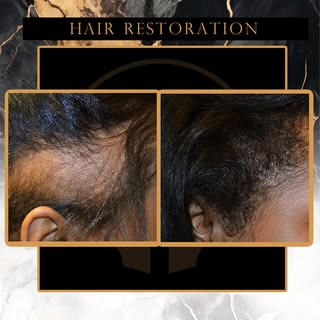 Ready to Restore Your Hair & Confidence?
💼 Meet with Dr. Patrick Narh-Martey, Georgia’s trusted exp
