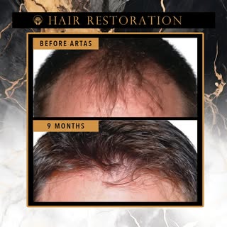 Struggling with Hair Loss? It’s Time to Take Control.
Restore your hairline — and your confidence — 