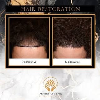 🧬 Regrow Your Hair – Without Surgery! 💥
For Men & Women | Limited-Time Offer
Struggling with hair 