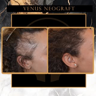 Struggling with Hair Loss? It’s Time to Take Control.
Restore your hairline — and your confidence — 