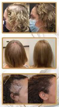 🧬 Regrow Your Hair – Without Surgery! 💥
For Men & Women | Limited-Time Offer
Struggling with hair 
