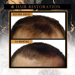🧬 Regrow Your Hair – Without Surgery! 💥
For Men & Women | Limited-Time Offer
Struggling with hair 