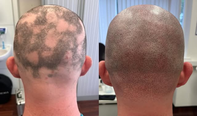 We are so grateful to our lovely client for allowing us to share their experience and #hairlossjourn