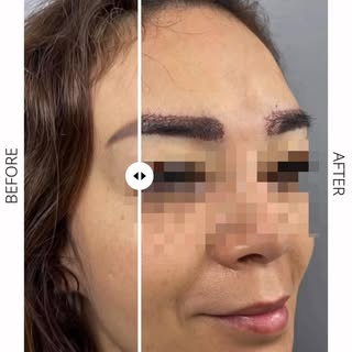💁🏽Впечатляющее восстановление бровей

📞Whatsapp: +995 591 024 004

🖇️https://tsilosaniclinic.com