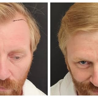👉🏻До и после пересадки волос

📞Whatsapp: +995 591 024 004

🌎 https://tsilosaniclinic.com/ru/