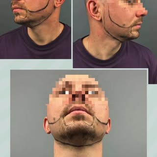 👉🏻До и после пересадки бороды

📞Whatsapp: +995 591 024 004

🌎 https://tsilosaniclinic.com/ru/