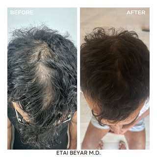 התוצאה המדהימה הזאת הגיעה לאחר אבחון מקיף ומדויק שבו החלטנו להתחיל טיפול ב PRP בשילוב עם אקסוזומים (