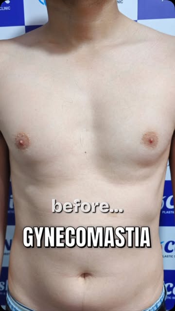 💪 Gynecomastia Before & After ✨

A visible change. A renewed sense of confidence. 🙌

See the trans