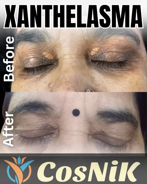 ✨ Xanthelasma Treatment — Before & After ✨

👀 Yellowish patches around the eyes can be Xanthelasma.