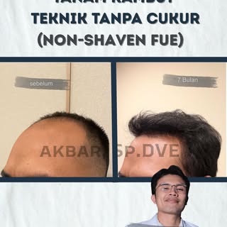 Tanam Rambut Tanpa Cukur (Non-Shaven FUE) ✨

Buat kamu yang ingin menambah kepadatan rambut tanpa ha