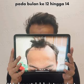 Hair transplant itu bukan hasil instan. 🌱

Rambut yang ditanam akan melewati proses pertumbuhan sec