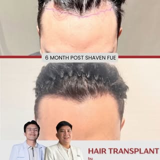 6 Months After Hair Transplant ✨

A new hairline, a new frame for the face.

Hair transplantation is
