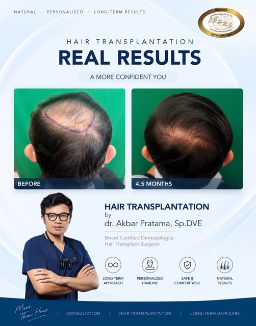 Real Results. Real Confidence. ✨

Progress 4.5 months after hair transplantation — and the journey i