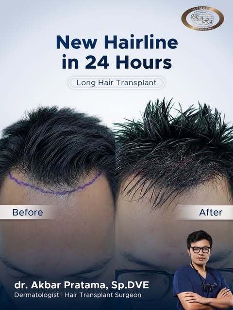 New hairline. A more youthful look. ✨

Hairline yang dirancang secara personal untuk proporsi wajah 