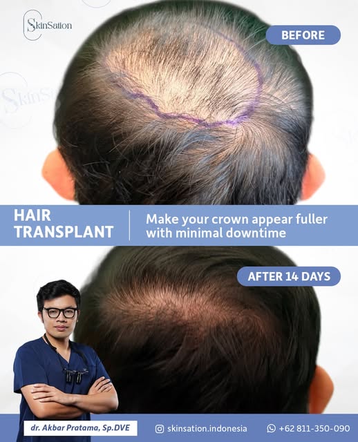 Don’t wait until it’s too late. If your hair part is widening and serums have stopped working, it’s 
