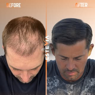 Witness what 2 years can achieve. ✨

James David’s hair transplant journey is the proof that patienc