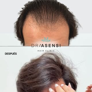Antes & Después trasplante capilar técnica FUE Long Hair en Asensi Clinic✅

Nuestro paciente apostó 