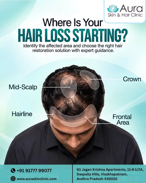 Where is your hair loss starting

Hair loss can affect different areas — from the hairline and front