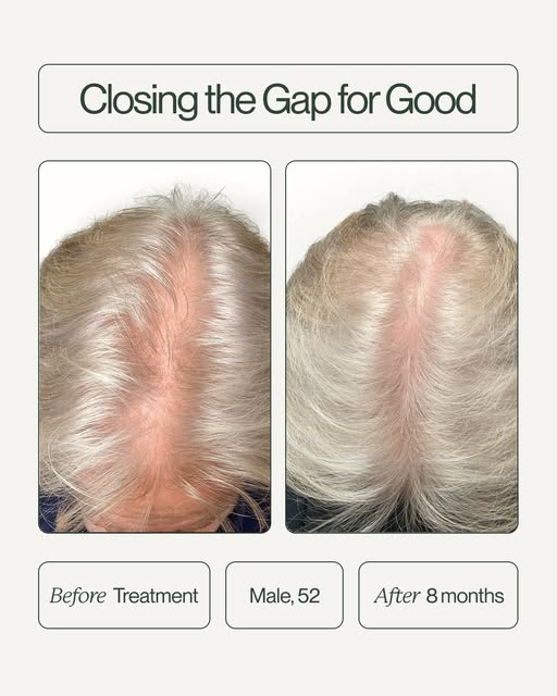 We're closing the gap on wide parts *and* misinformation about hair loss. ⁠
⁠
Head to the link in bi