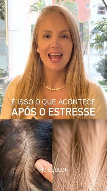 É isso o que acontece após um estresse muito grande: meses depois, os fios despencam de uma vez.

Pa
