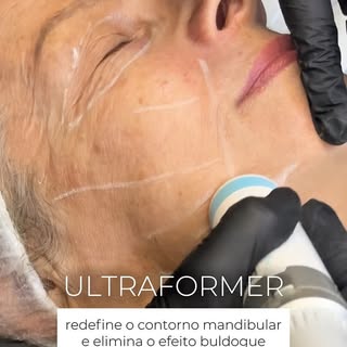 O protocolo com Ultraformer MPT redefine o contorno mandibular e o terço inferior da face em uma úni