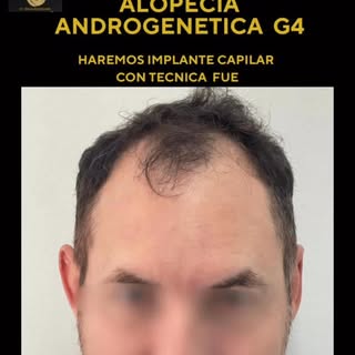 Implante Capilar en Alopecia Androgenética grado 4.
 
#injertodepelochile #implantedepelochile #calv