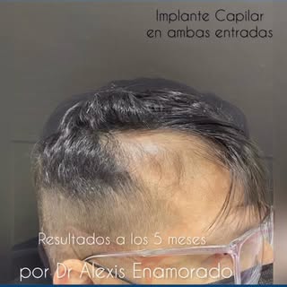 Restauración Capilar de ambas entradas.
Técnica FUE

#injertodepelochile #implantedepelochile #calvi