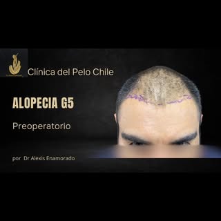 Alopecia Androgenética Grado 5.
La Restauración Capilar quirúrgica es una alternativa que otorga res